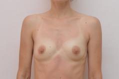 Po mamoplastiki - kaj ne storiti pri povečanju prsi