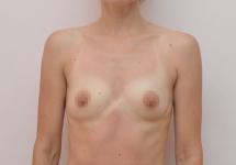 Po mamoplastiki - kaj ne storiti pri povečanju prsi